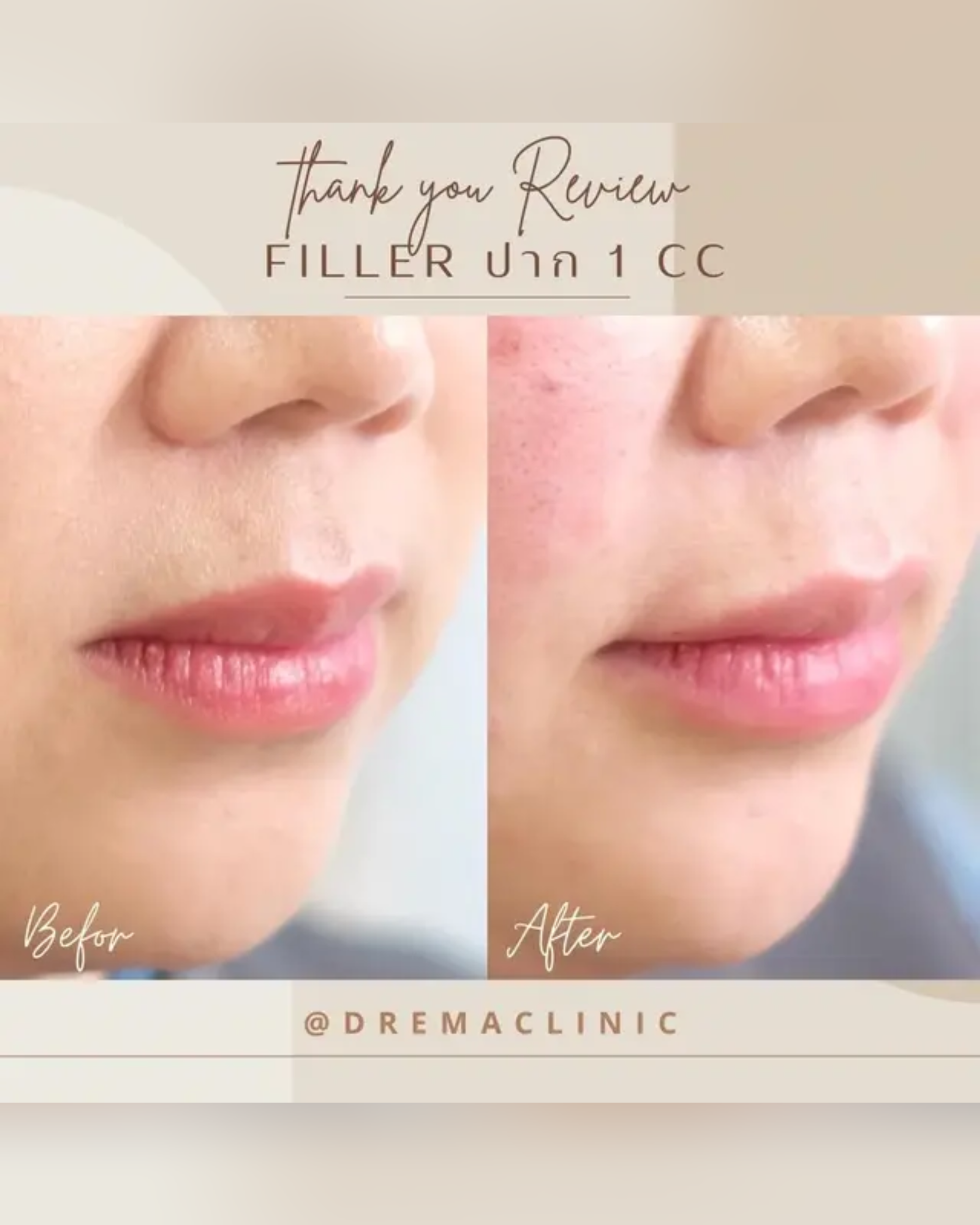 lip-filler - Drema Clinic