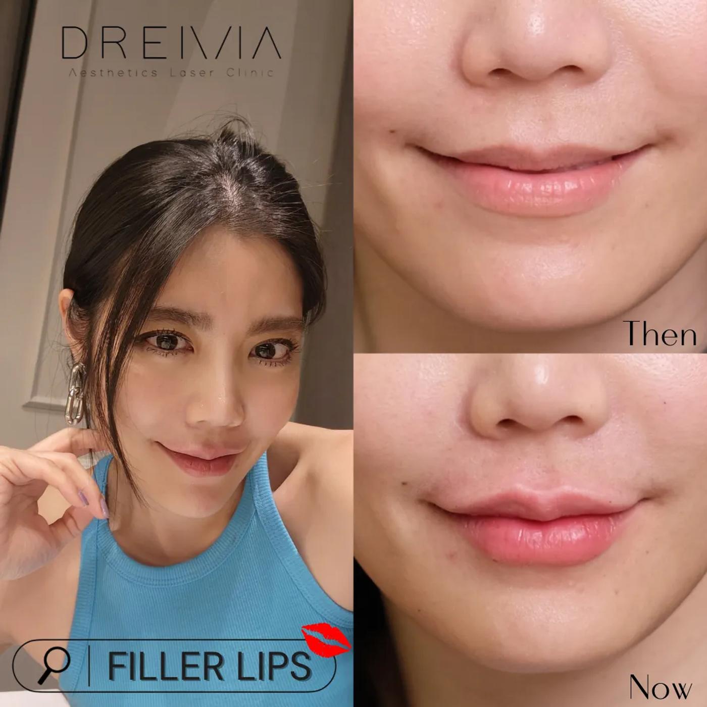 รีวิว Filler ปาก 32
