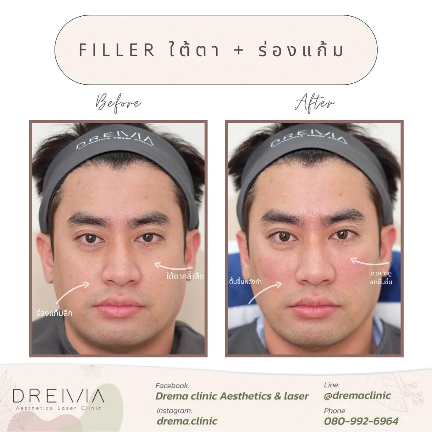 รีวิวฟิลเลอร์ใต้ตา 9