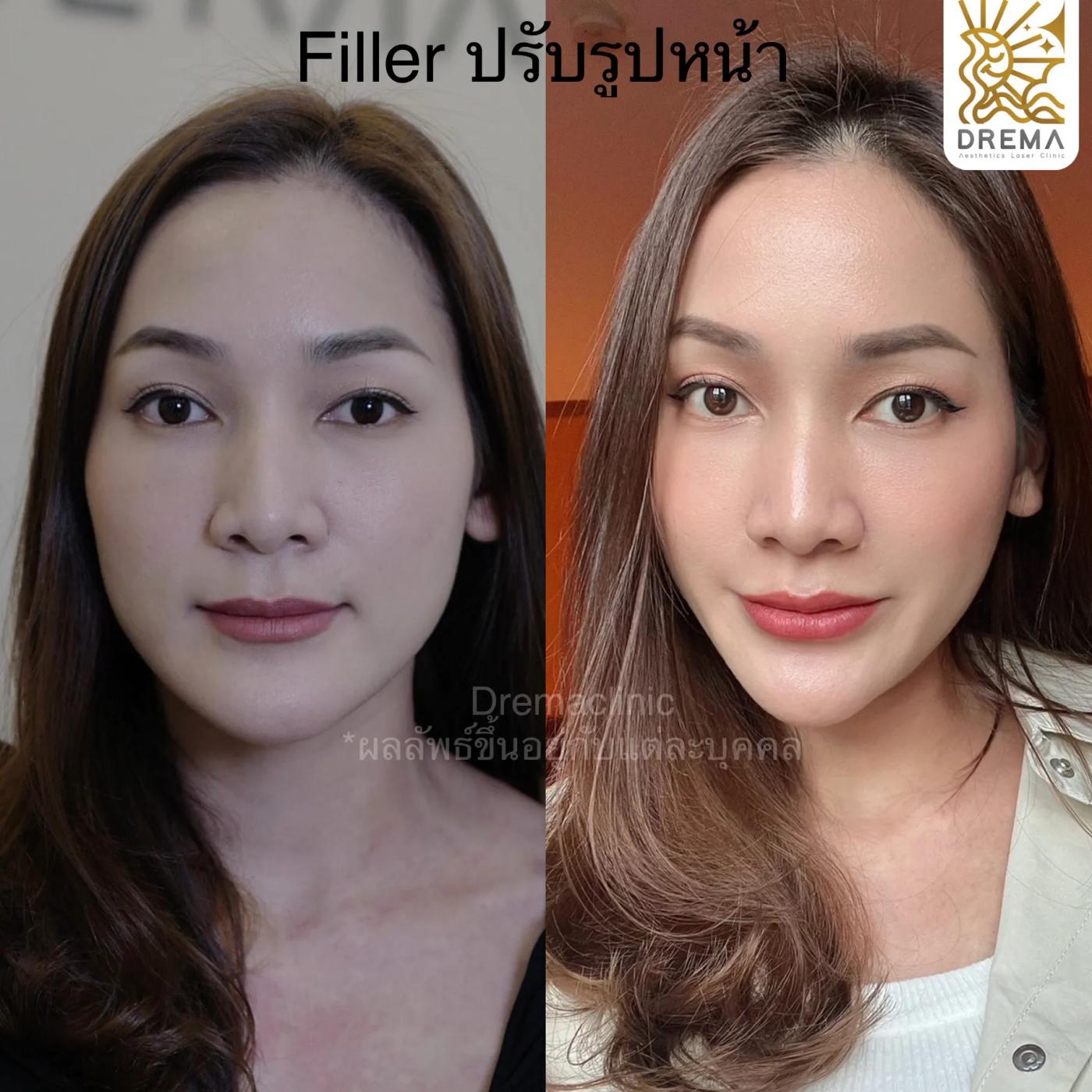 รีวิวการปรับรูปหน้า 4
