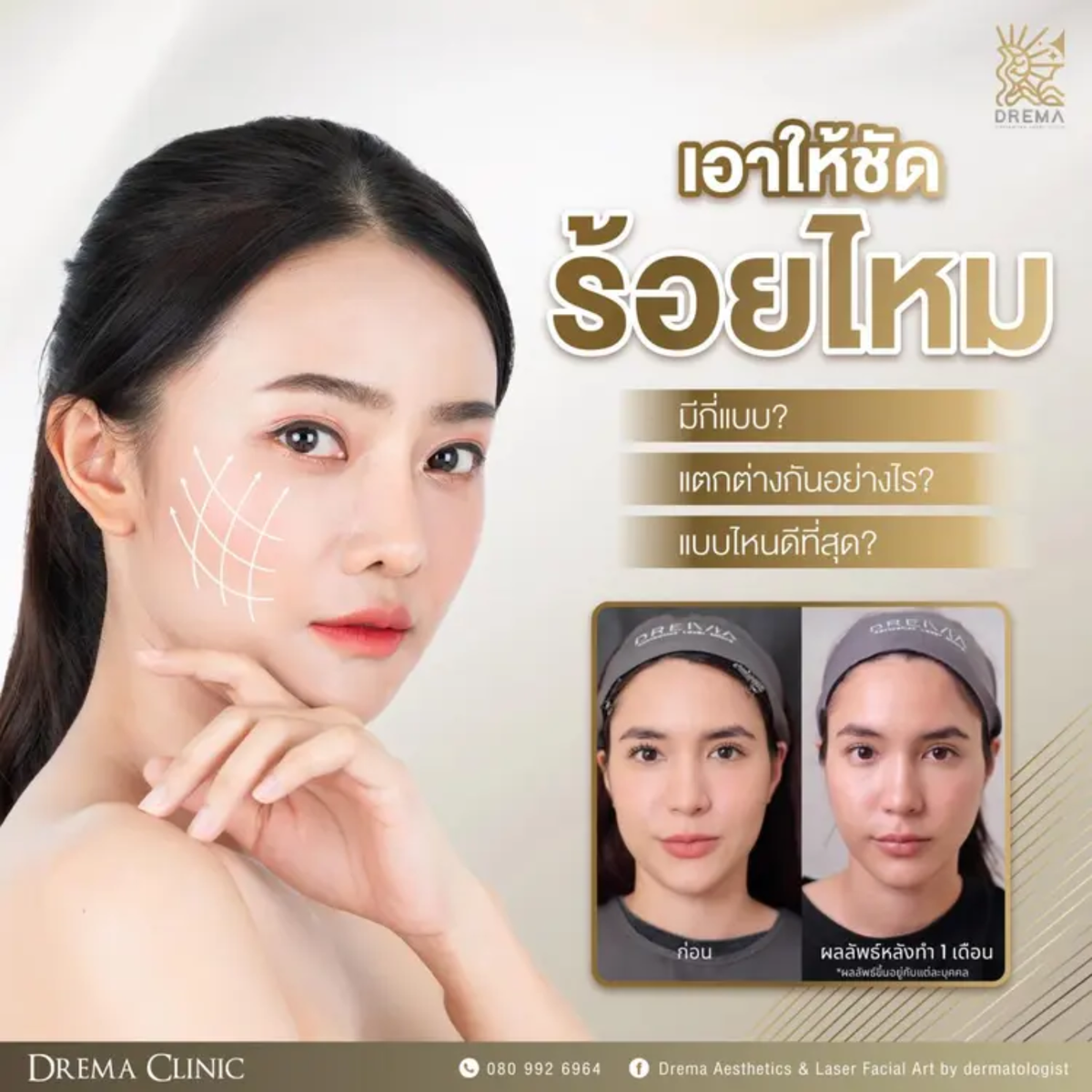 เอาให้ชัด ร้อยไหมมีกี่แบบ แตกต่างกันอย่างไร แบบไหนดีที่สุด - Drema Clinic