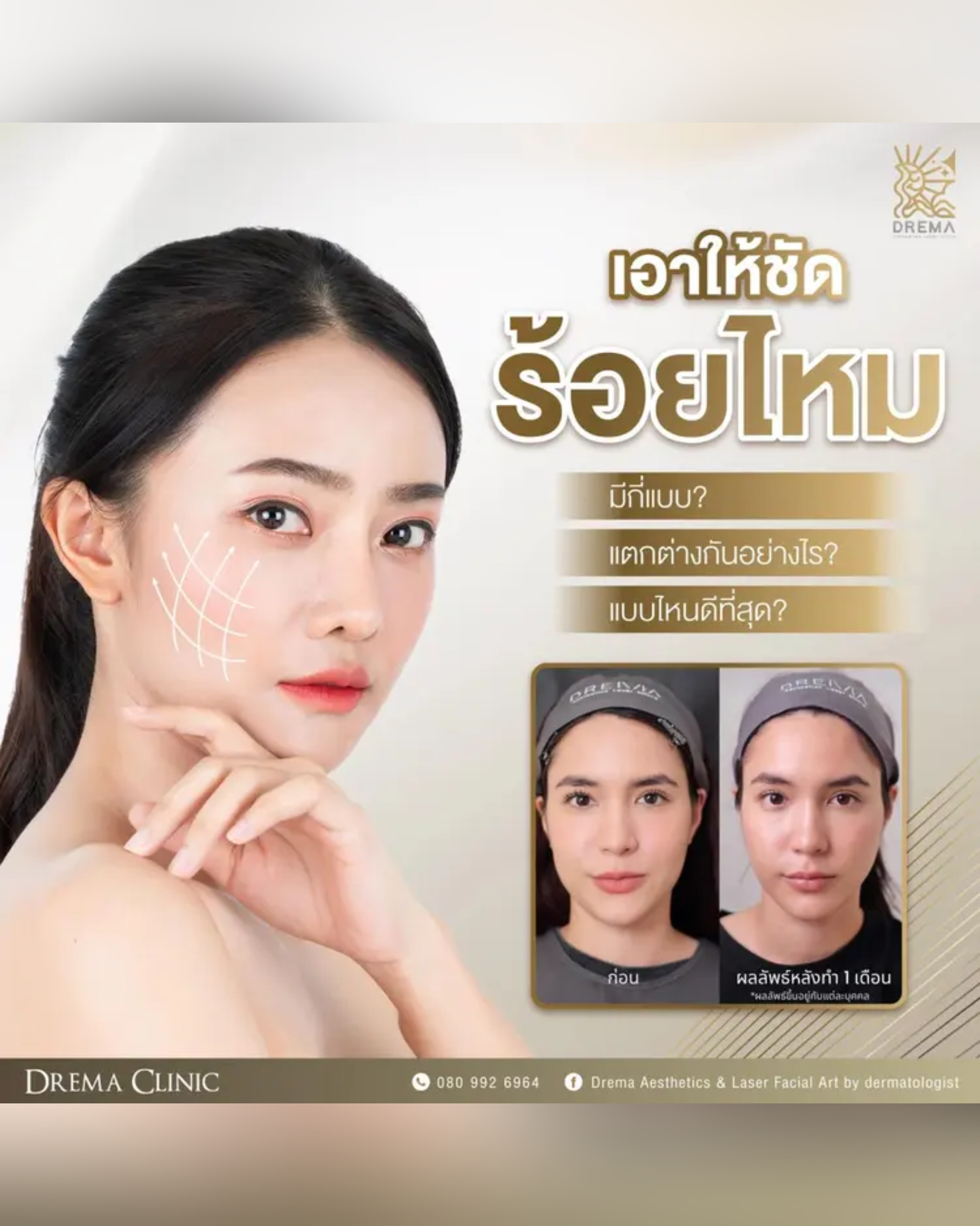 เอาให้ชัด ร้อยไหมมีกี่แบบ แตกต่างกันอย่างไร แบบไหนดีที่สุด - Drema Clinic