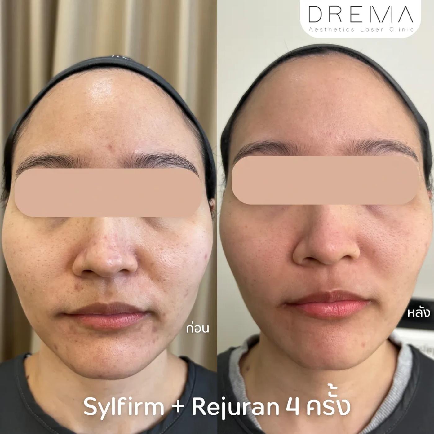 รีวิว SYLFIRM X 13