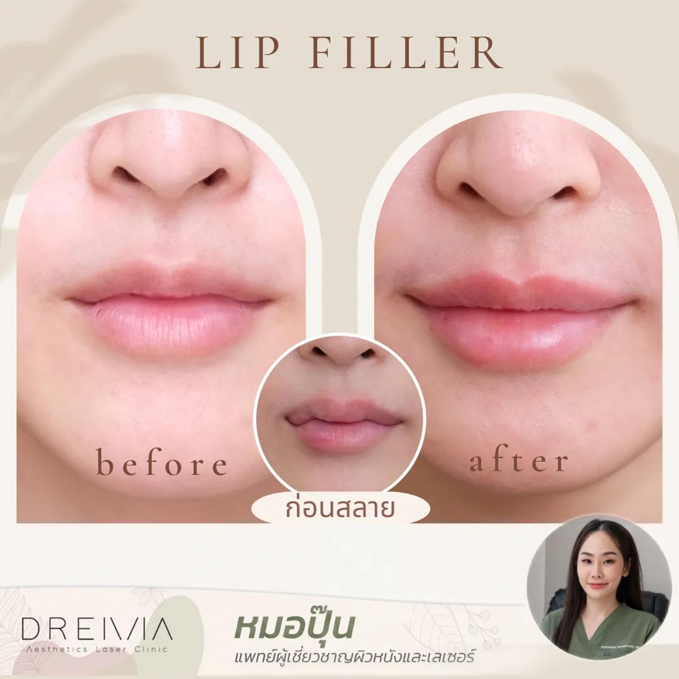 รีวิว Filler ปาก 4