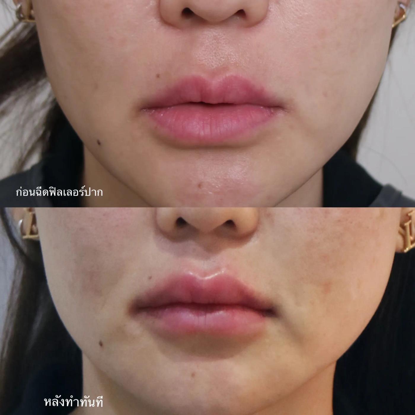 รีวิว Filler ปาก 33