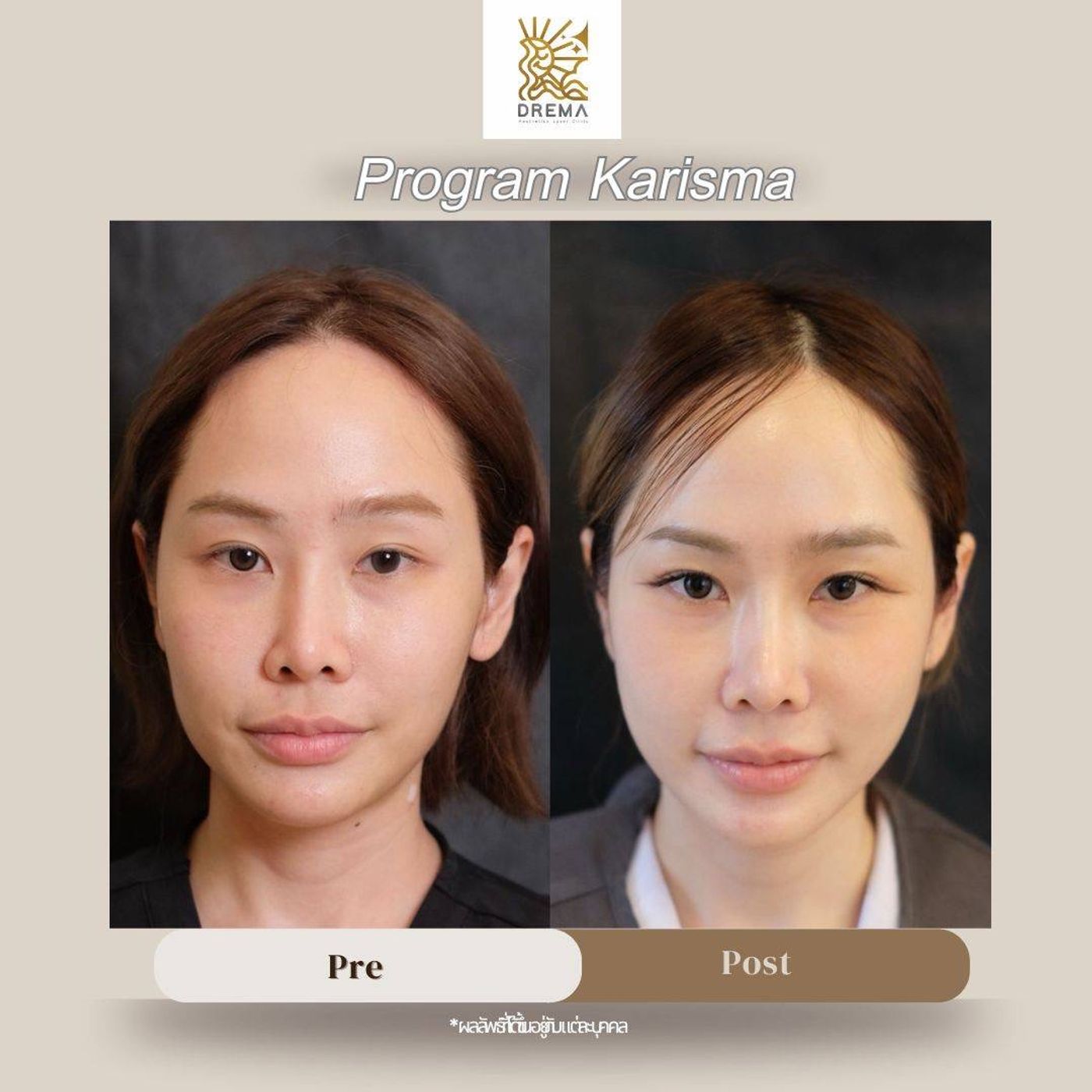 รูปรีวิว Skin Booster Drema Clinic เคสที่ 22