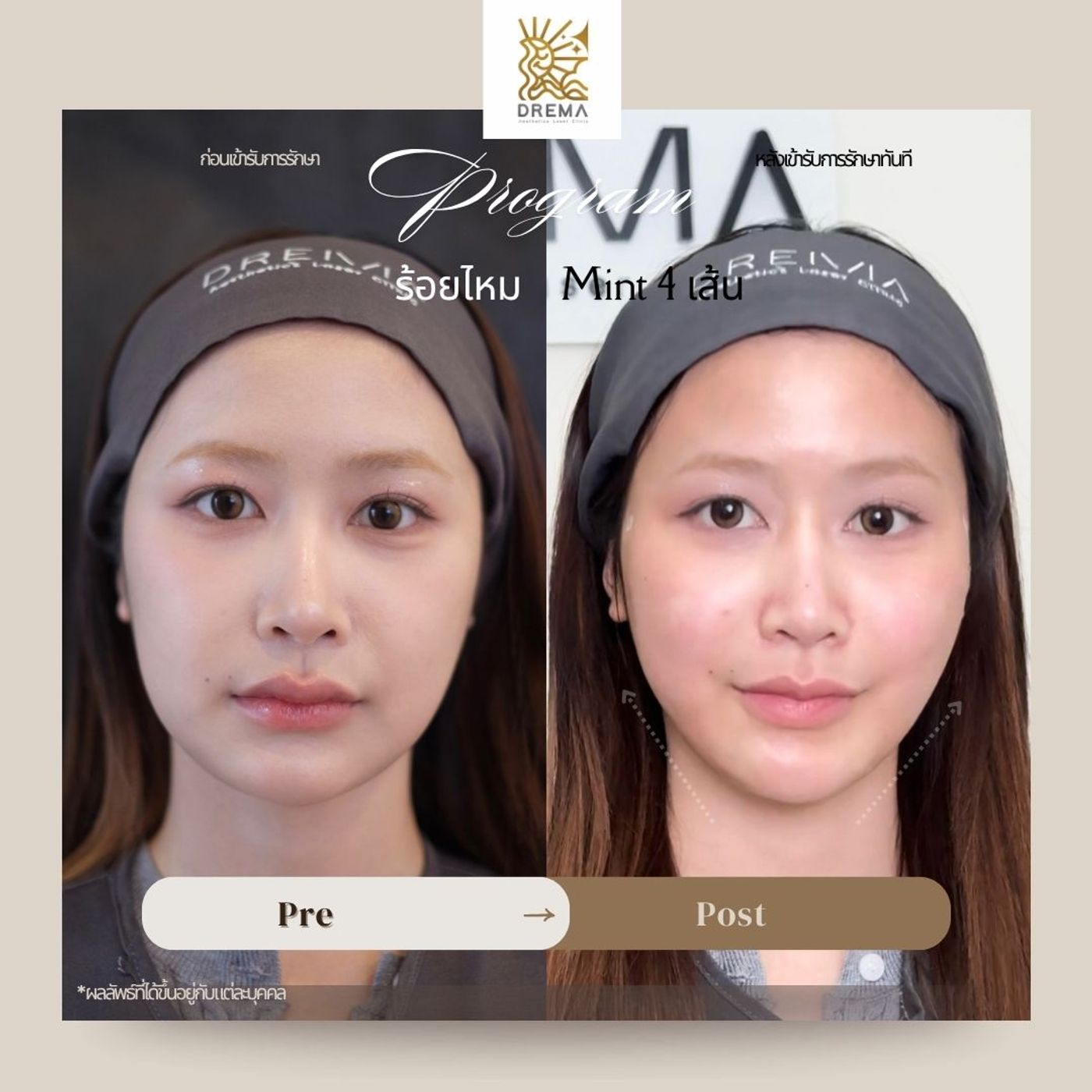 รูปรีวิว ร้อยไหม Drema Clinic เคสที่ 12