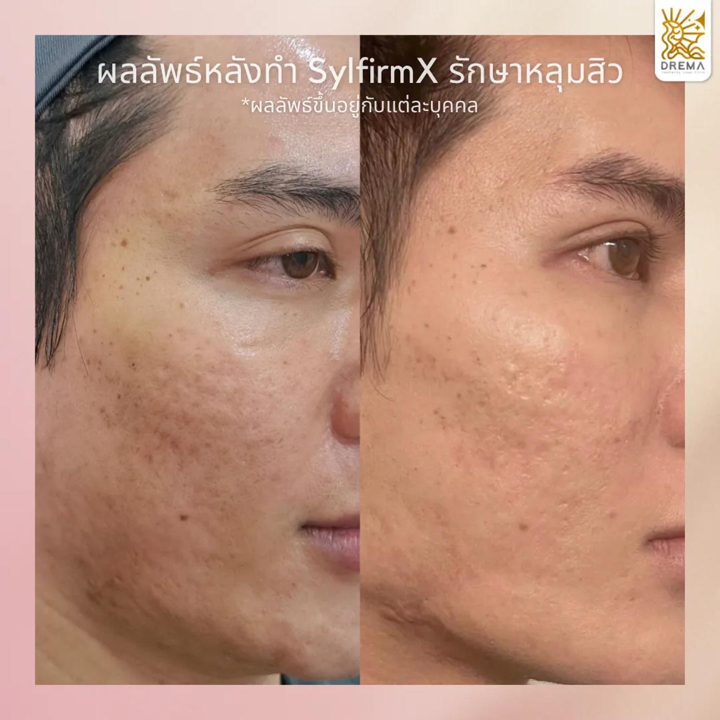 รีวิว SYLFIRM X 5
