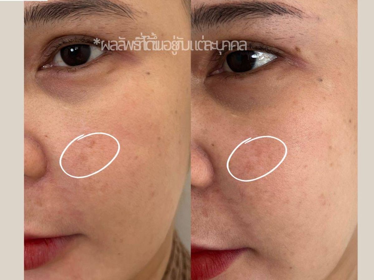 รีวิว Pico Drema Clinic