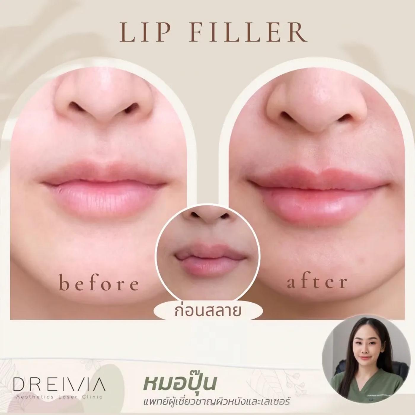 รีวิว Filler ปาก 22