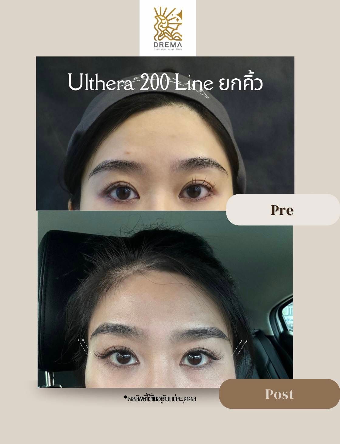 รูปรีวิว Ulthera Drema Clinic เคสที่ 9