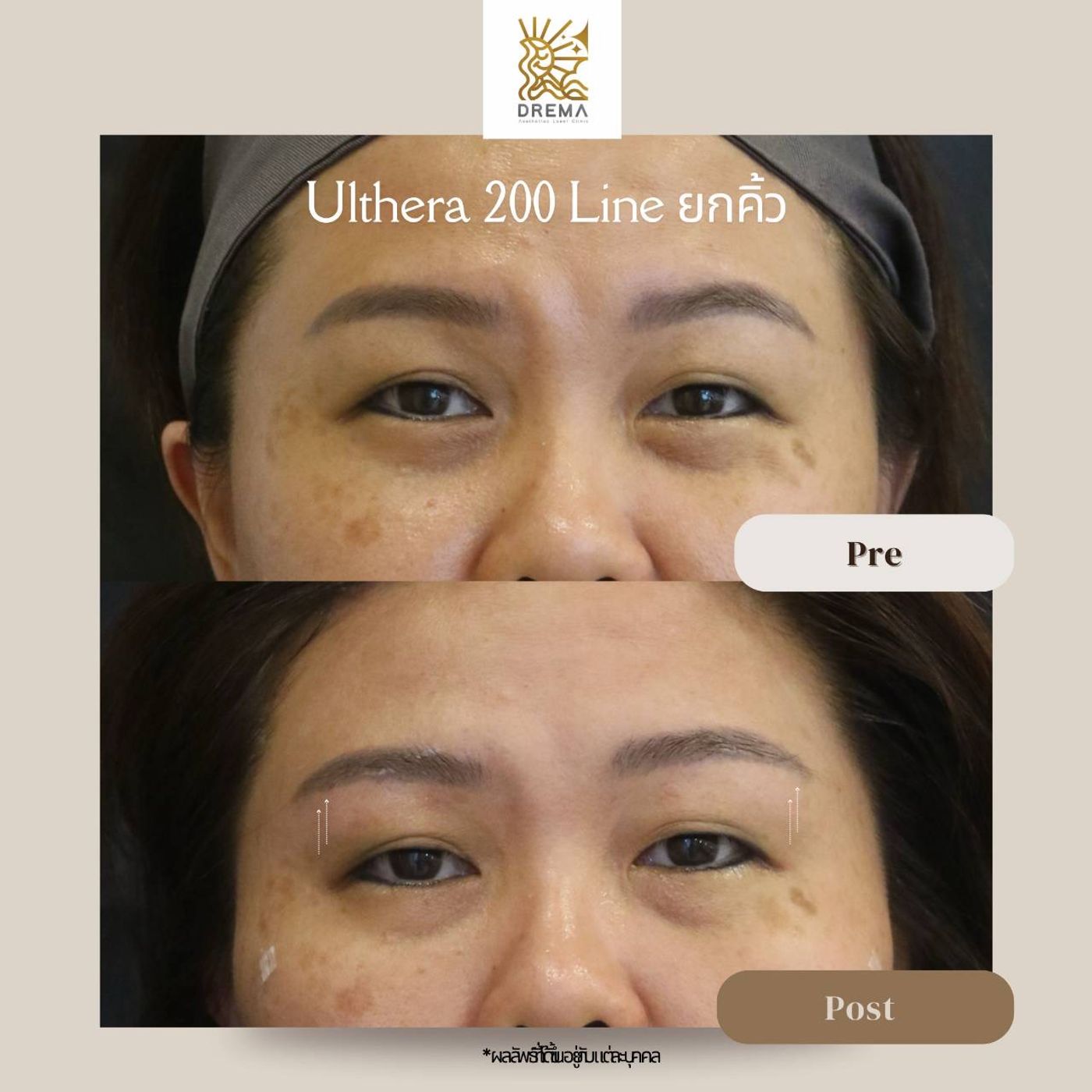 รูปรีวิว Ulthera Drema Clinic เคสที่ 11