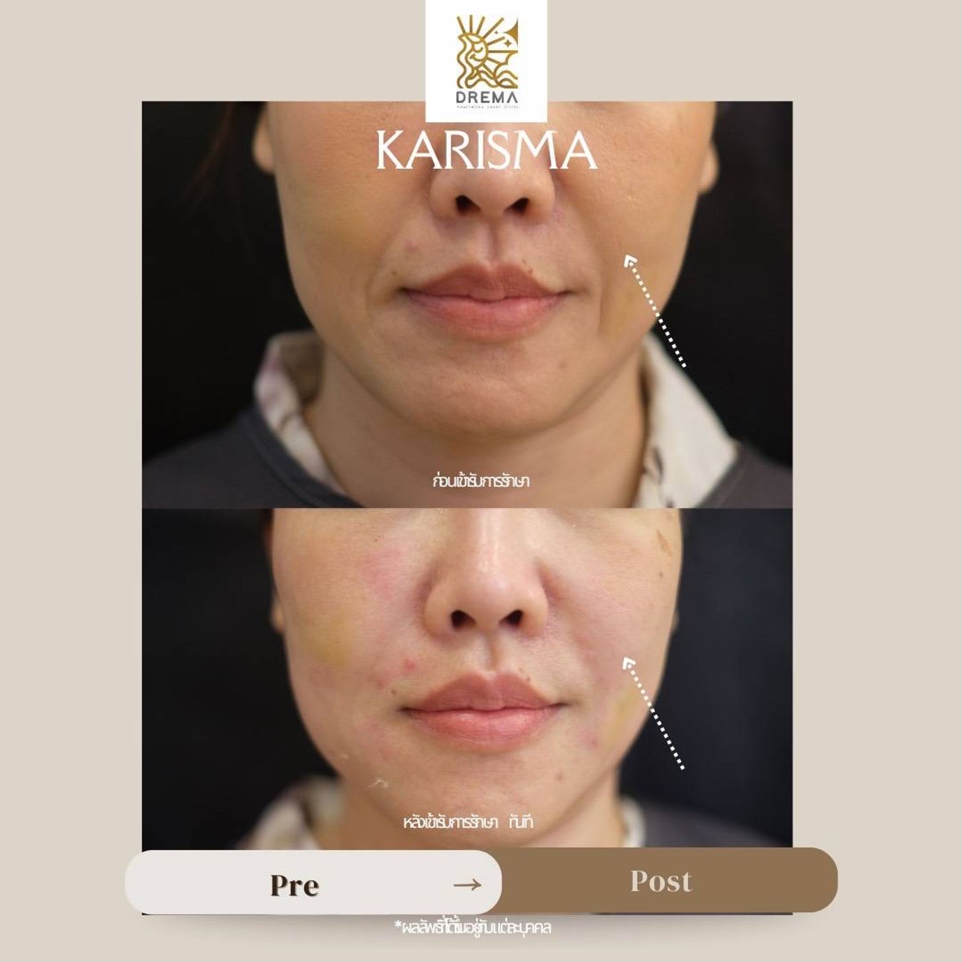 รูปรีวิว Skin Booster Drema Clinic เคสที่ 7