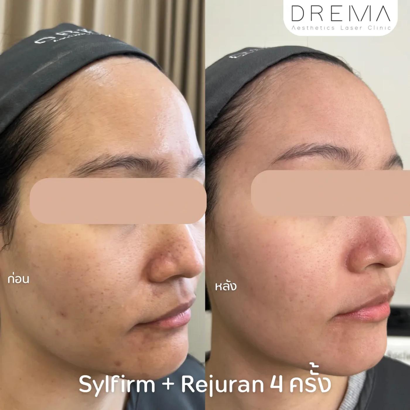รีวิว SYLFIRM X 4