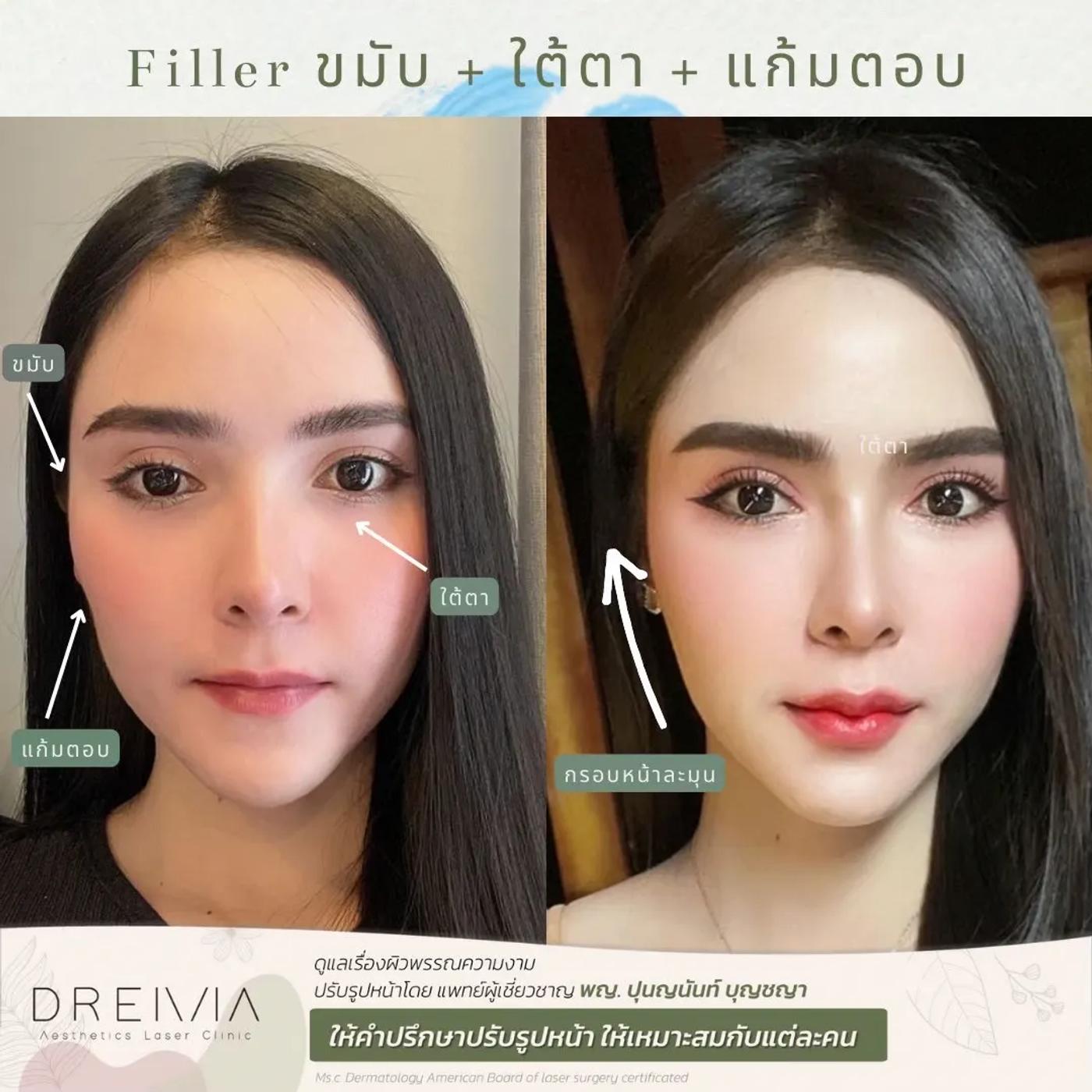 รีวิวการปรับรูปหน้า 13
