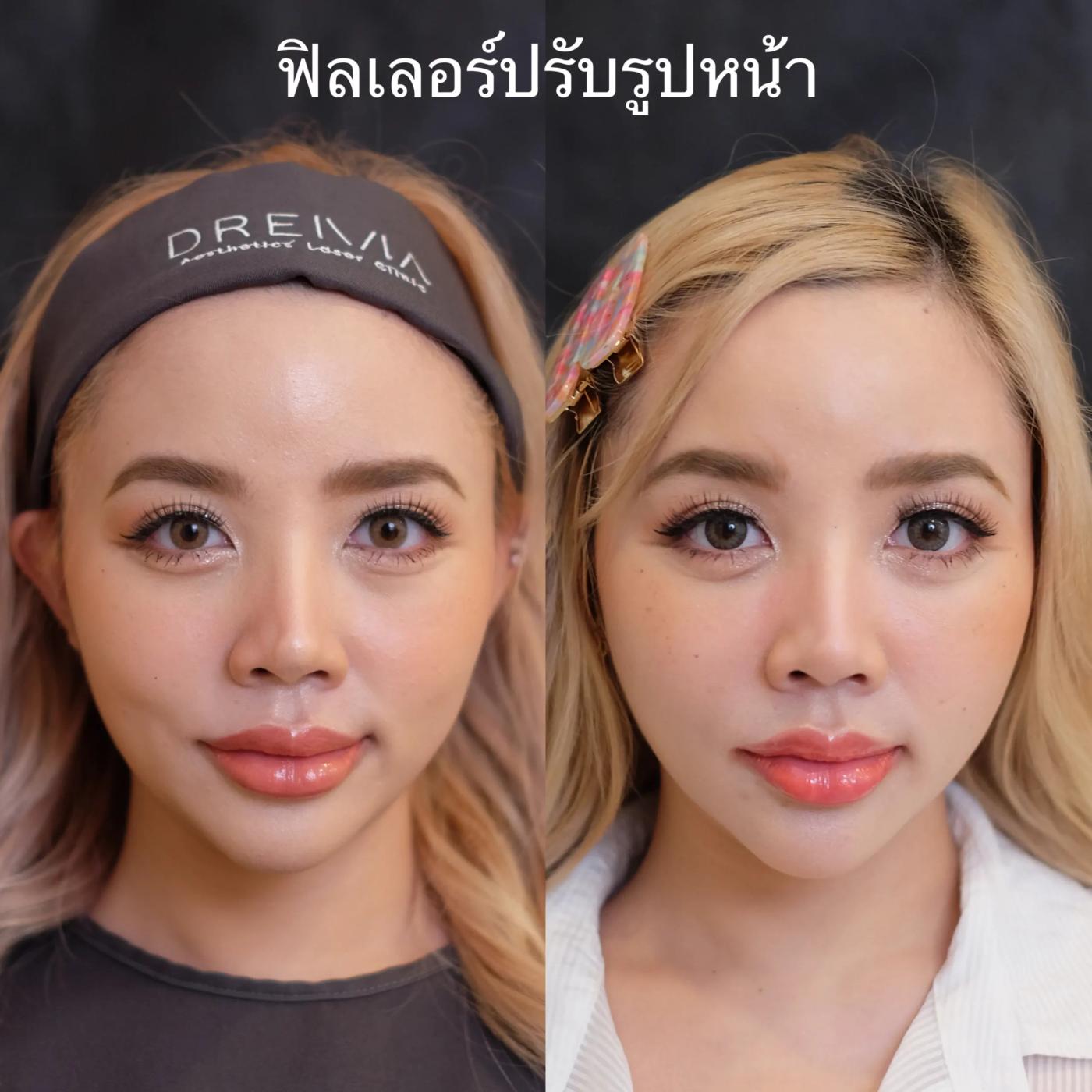 รีวิว Filler แก้มตอบ 3