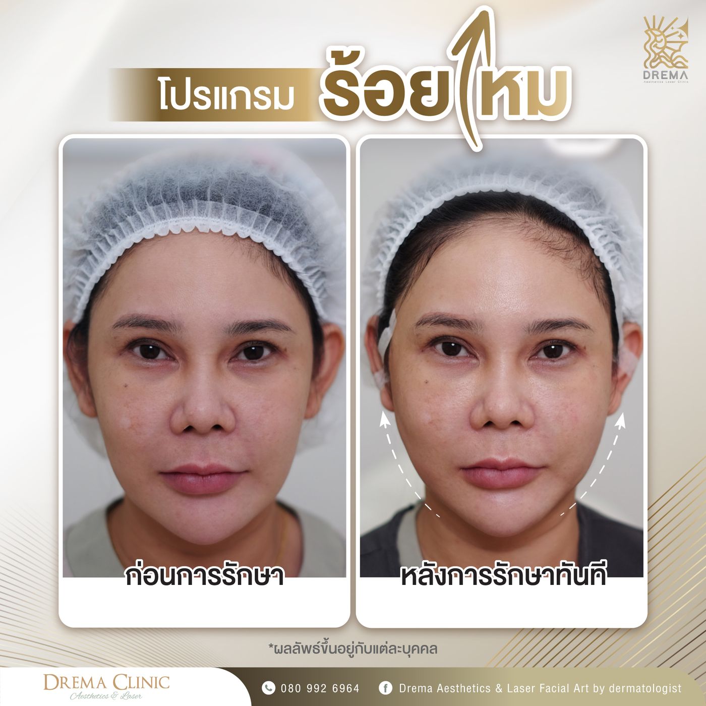 รูปรีวิว ร้อยไหม Drema Clinic เคสที่ 16