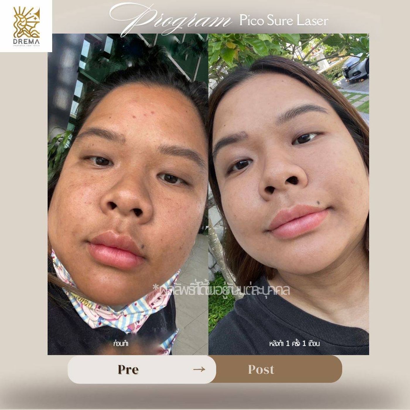รูปรีวิว Pico Drema Clinic เคสที่ 5