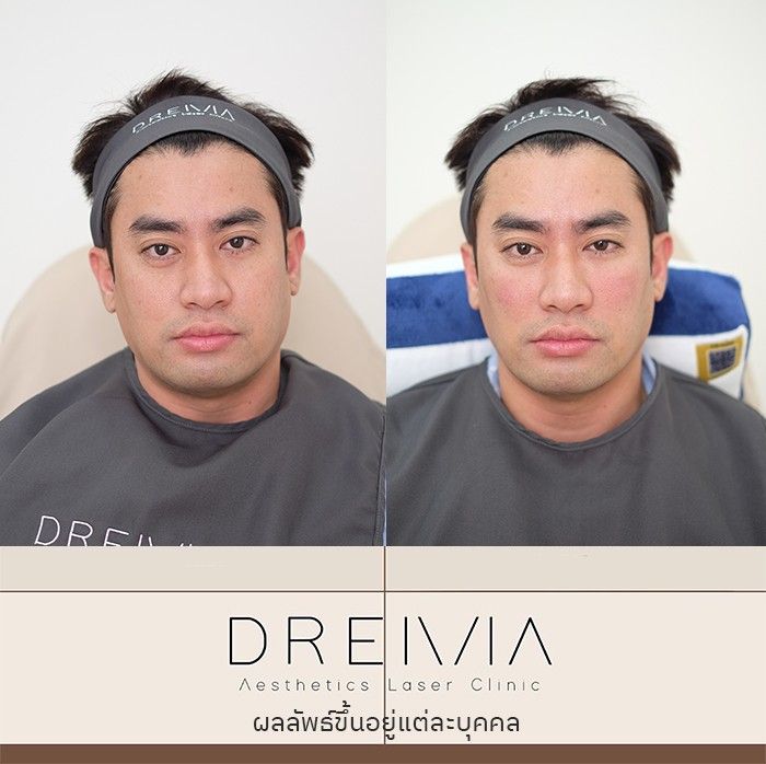 รีวิวฟิลเลอร์ใต้ตา 16