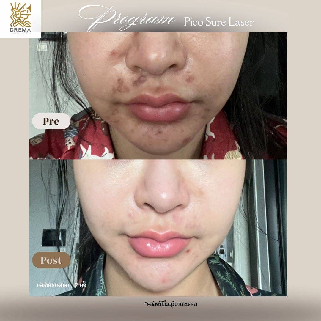 รูปรีวิว Pico Drema Clinic เคสที่ 1