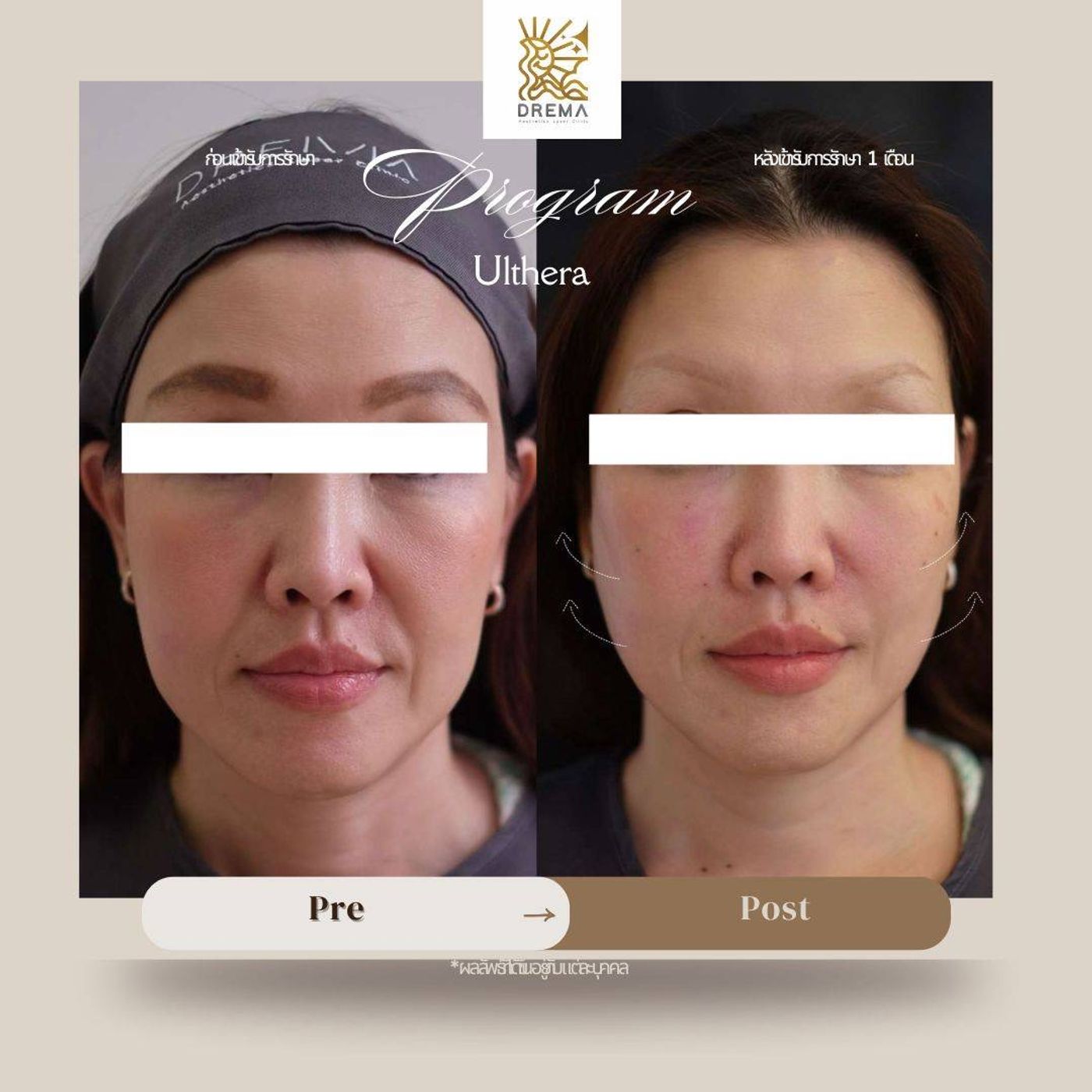 รูปรีวิว Ulthera Drema Clinic เคสที่ 1