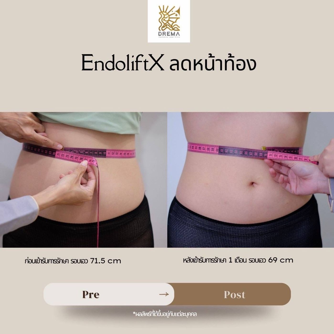 รูปรีวิว Endolift Drema Clinic เคสที่ 12
