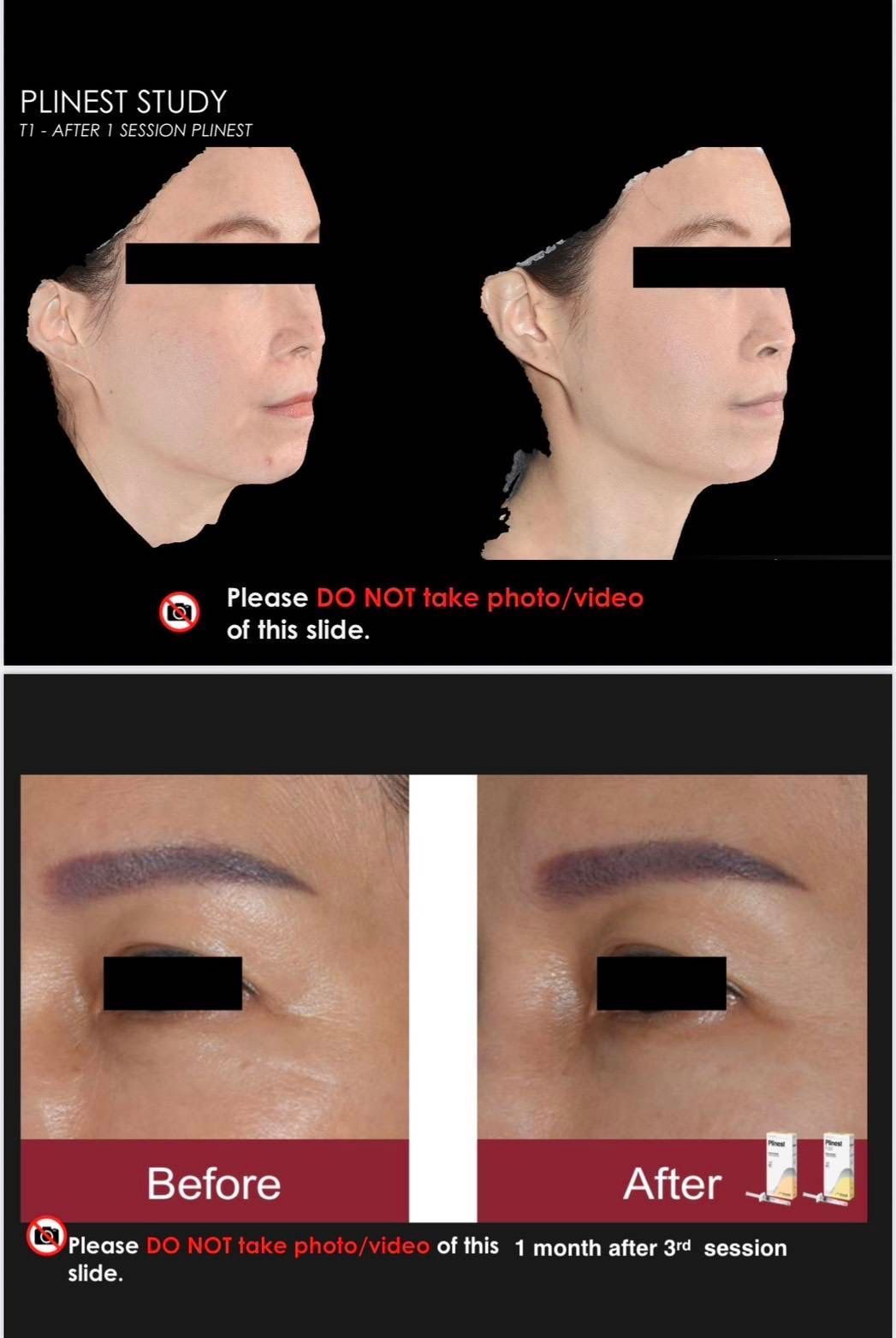 รูปรีวิว Skin Booster Drema Clinic เคสที่ 15