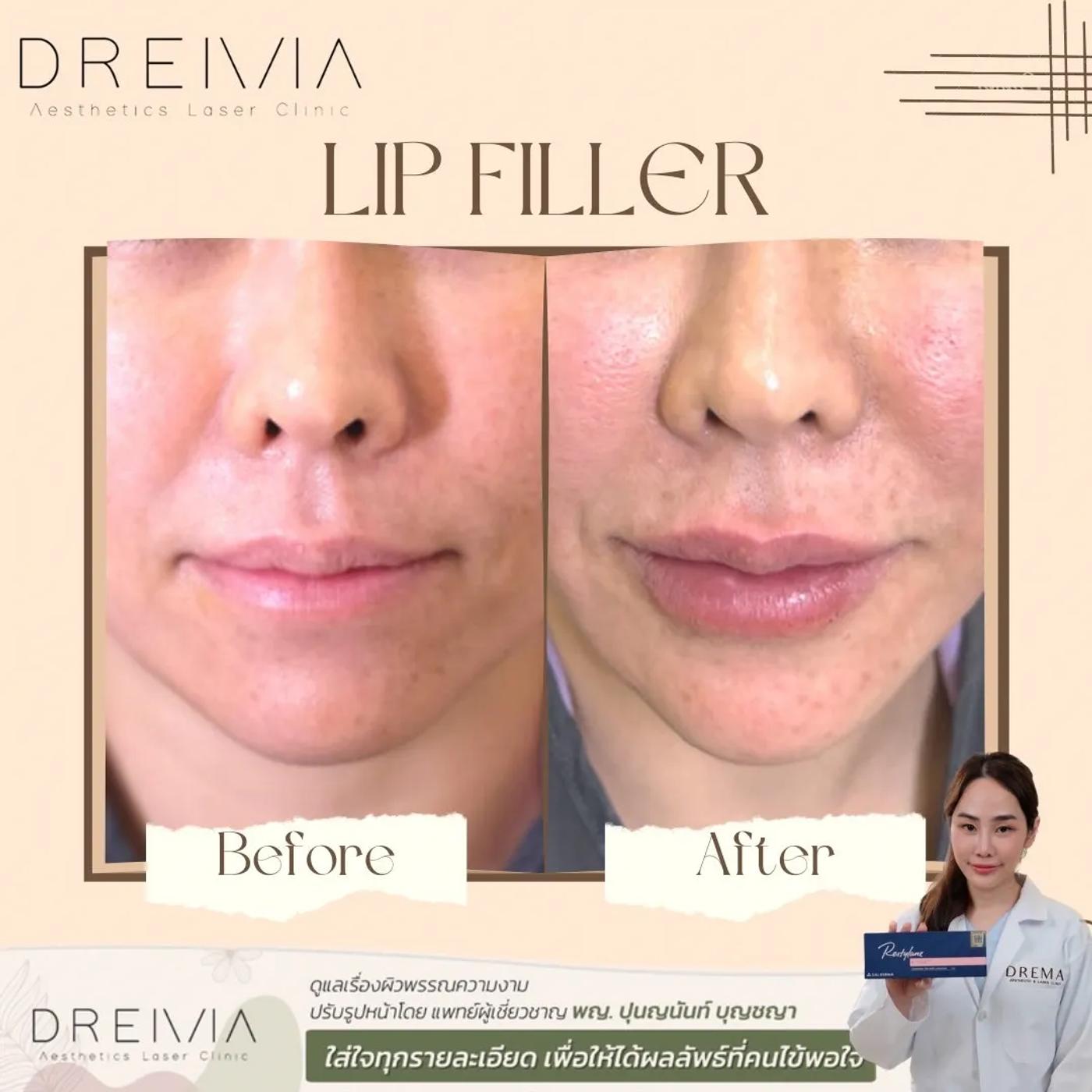 รีวิว Filler ปาก 15