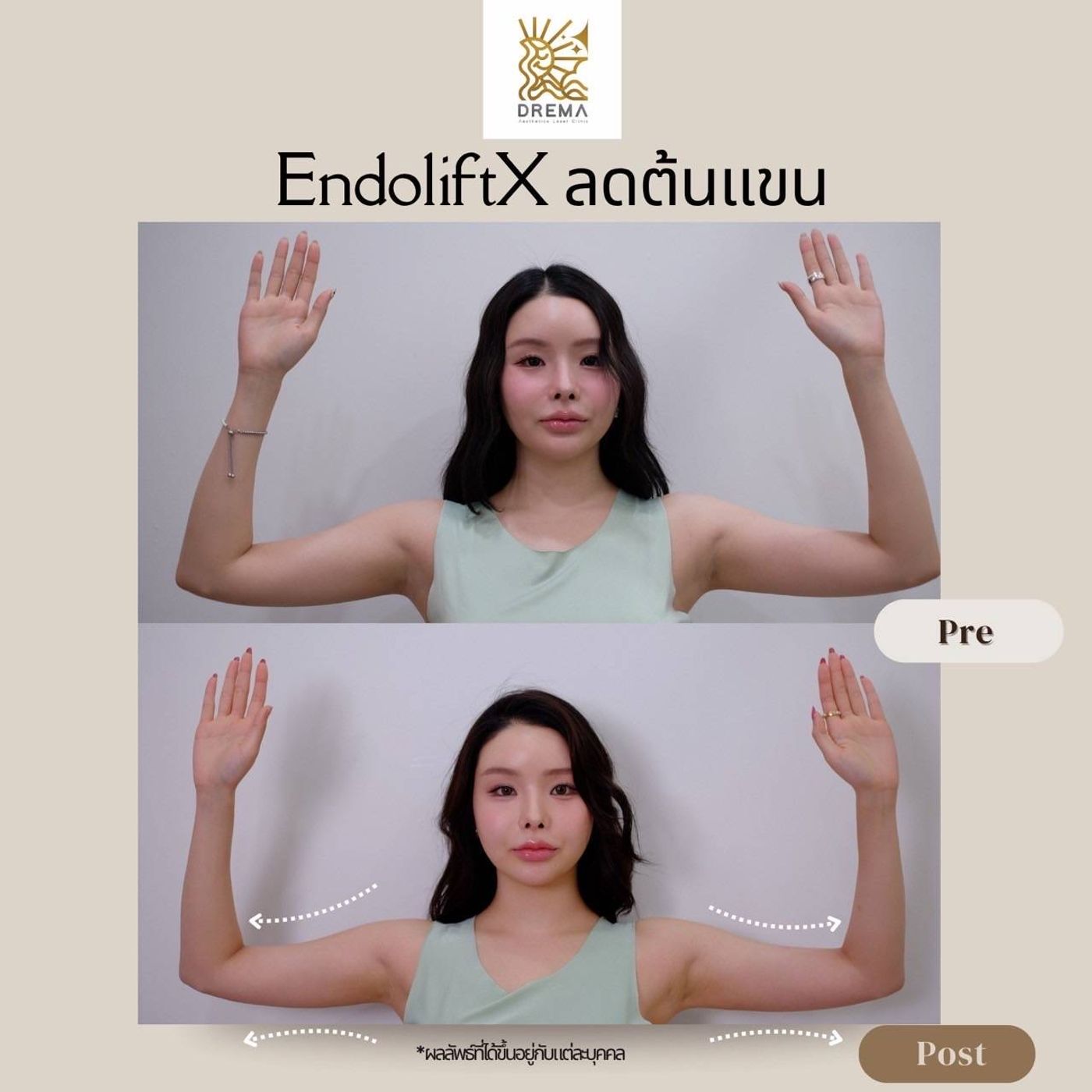 รูปรีวิว Endolift Drema Clinic เคสที่ 11