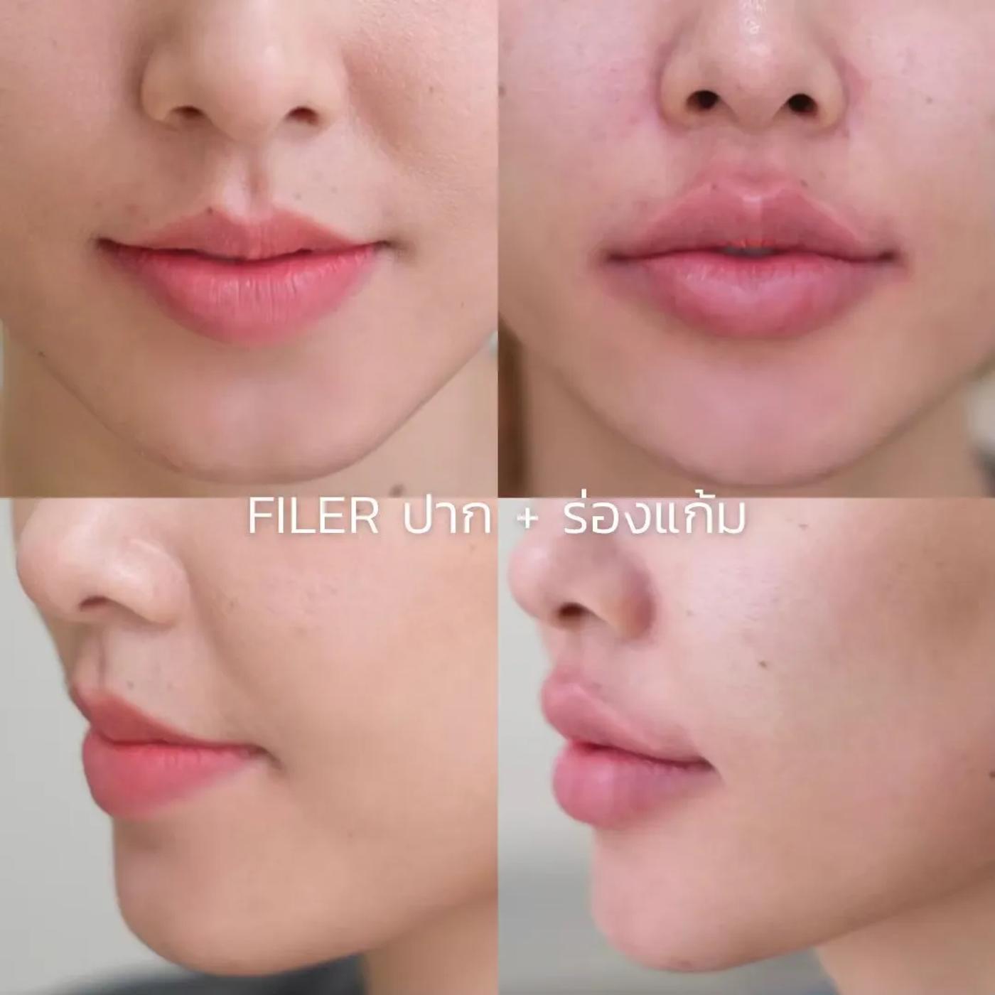 รีวิว Filler ปาก 37