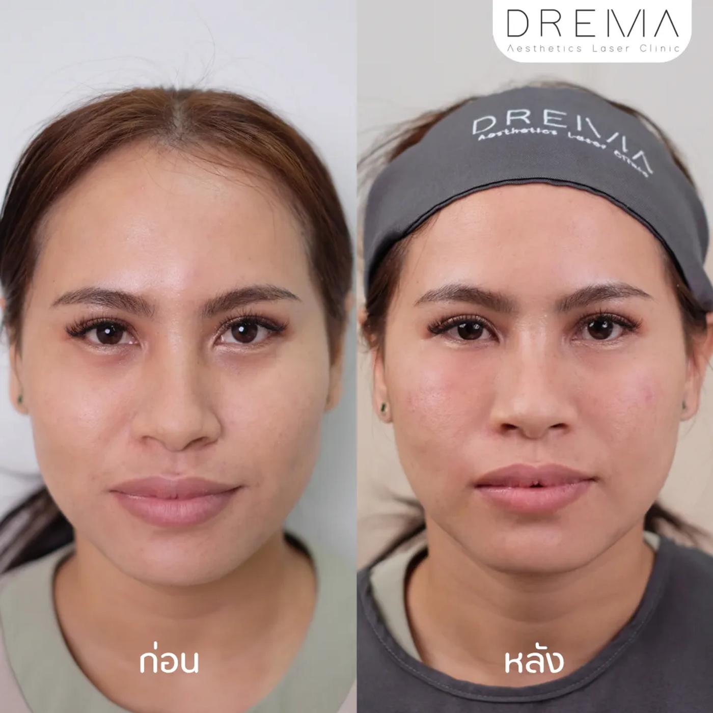 รีวิวฟิลเลอร์ใต้ตา 2