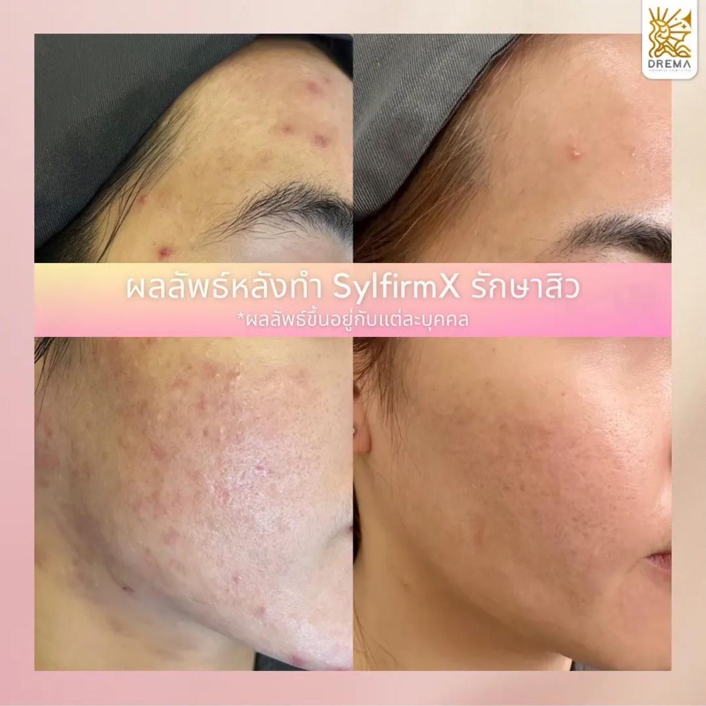 รีวิว SYLFIRM X 21