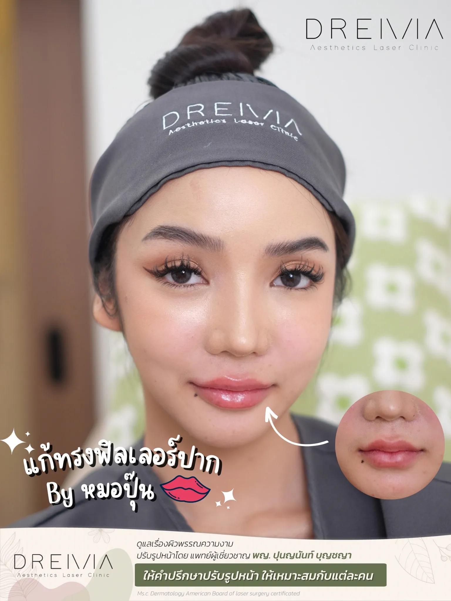รีวิว Filler ปาก 12