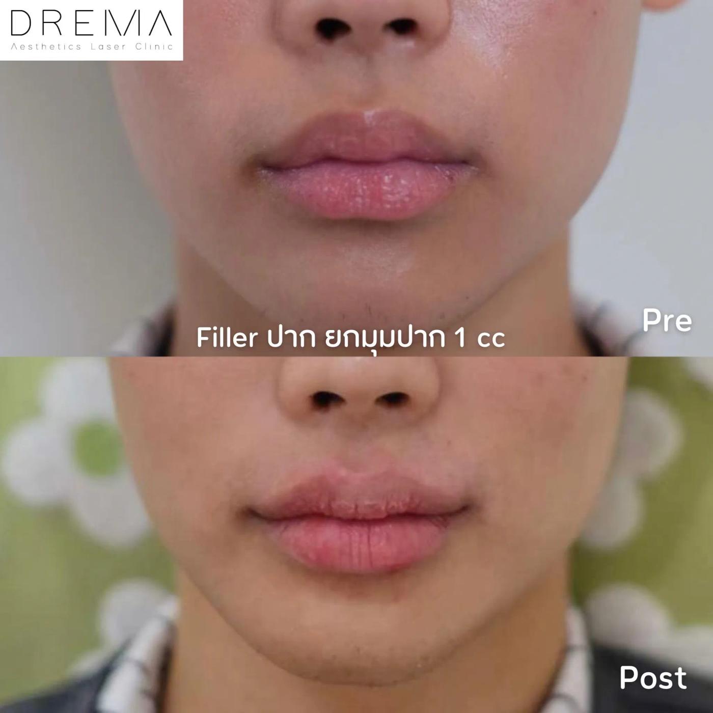 รีวิว Filler ปาก 10
