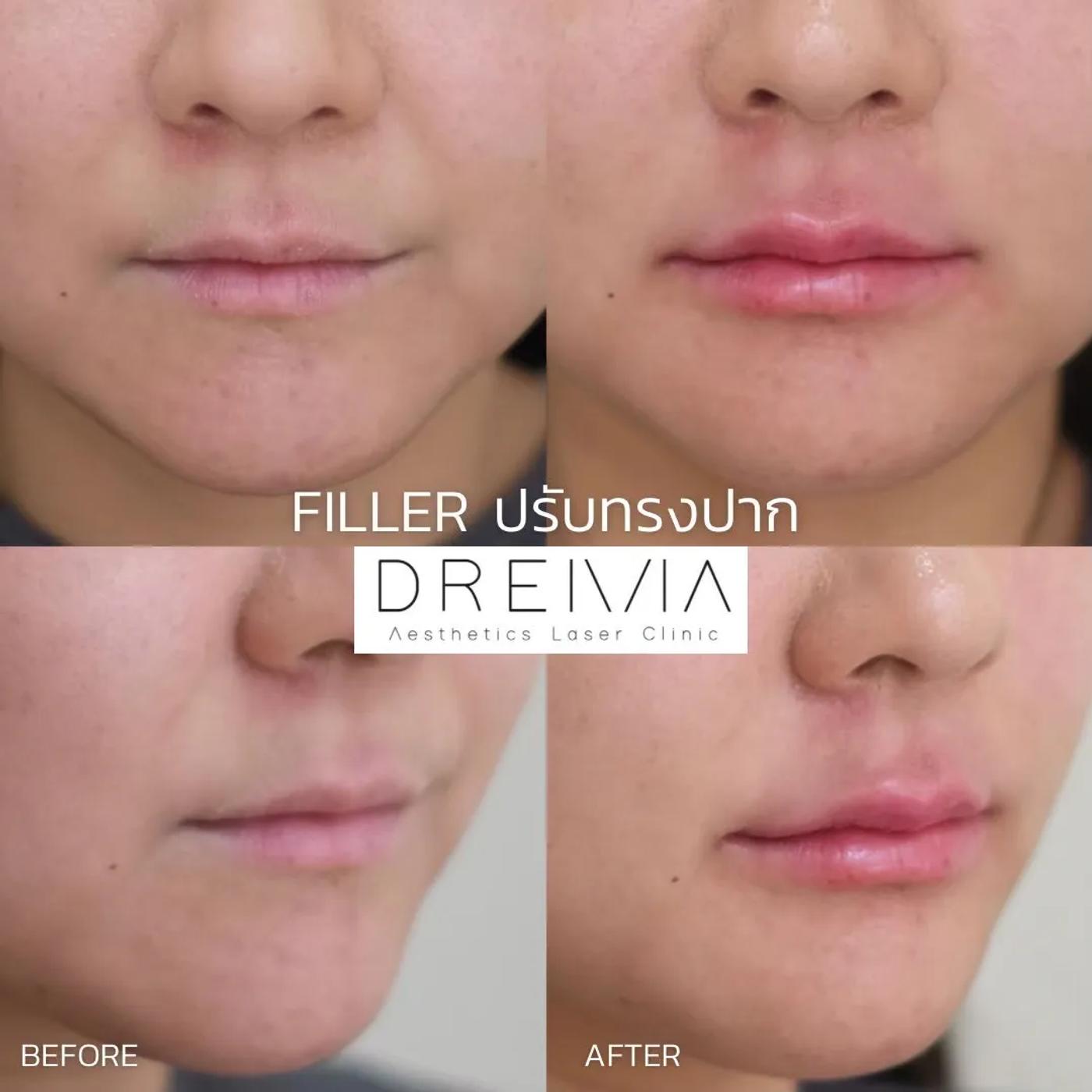 รีวิว Filler ปาก 36
