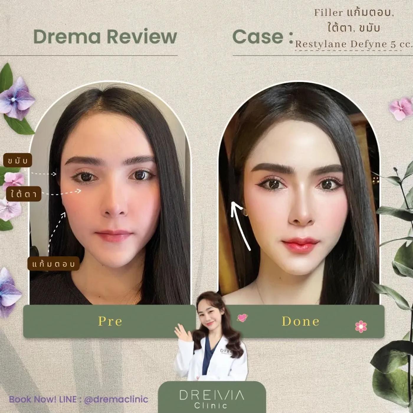 รีวิวการปรับรูปหน้า 12