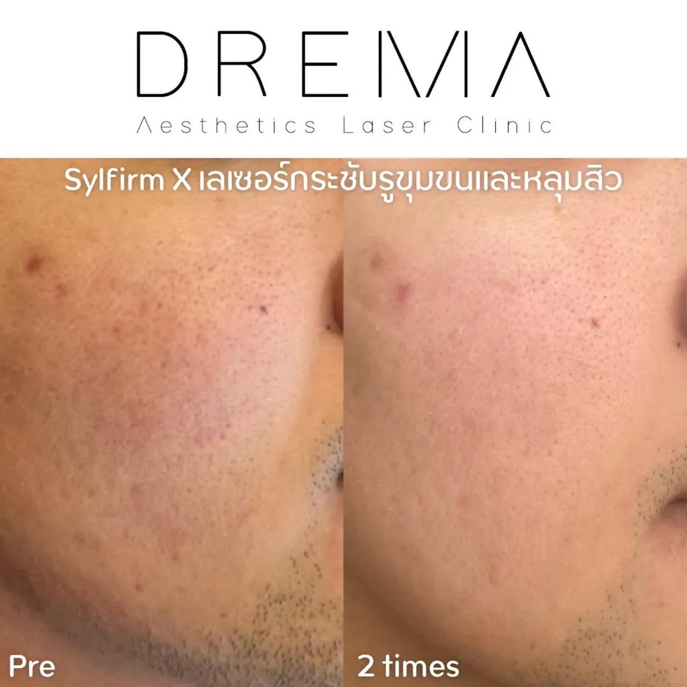 รีวิว SYLFIRM X 26