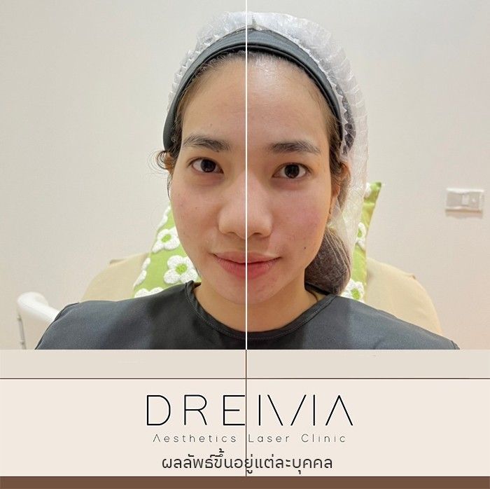 รีวิวฟิลเลอร์ใต้ตา 17
