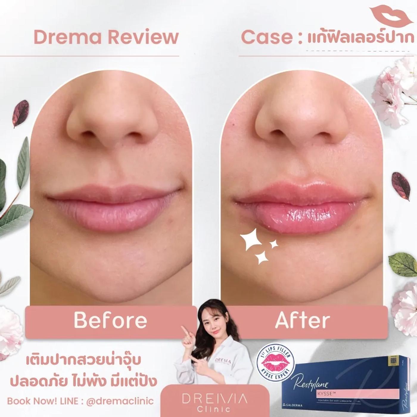 รีวิว Filler ปาก 19