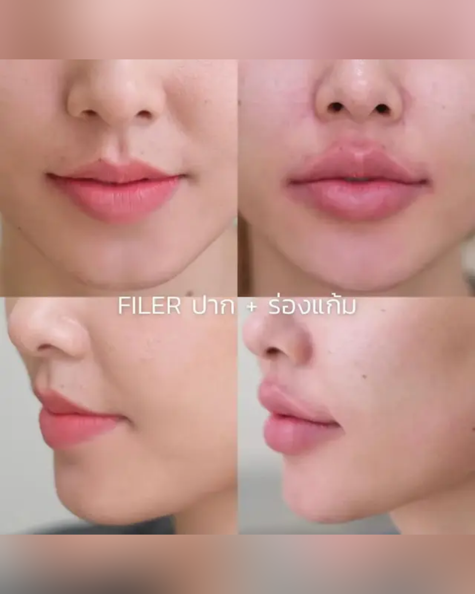 lip-filler-technique - Drema Clinic
