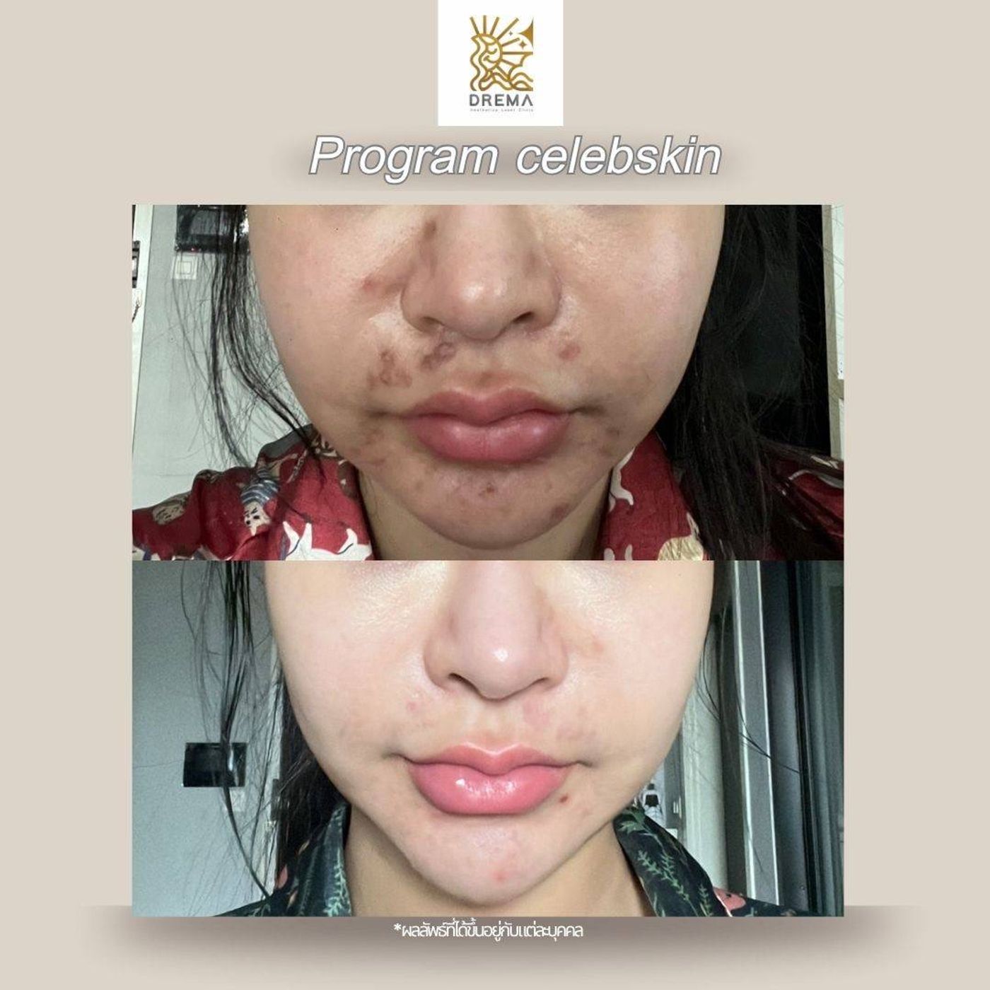 รูปรีวิว Skin Booster Drema Clinic เคสที่ 5
