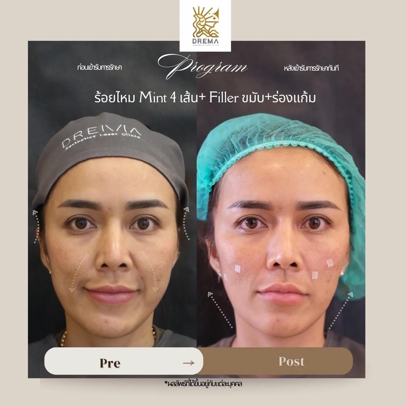รีวิว Filler แก้มตอบ 6
