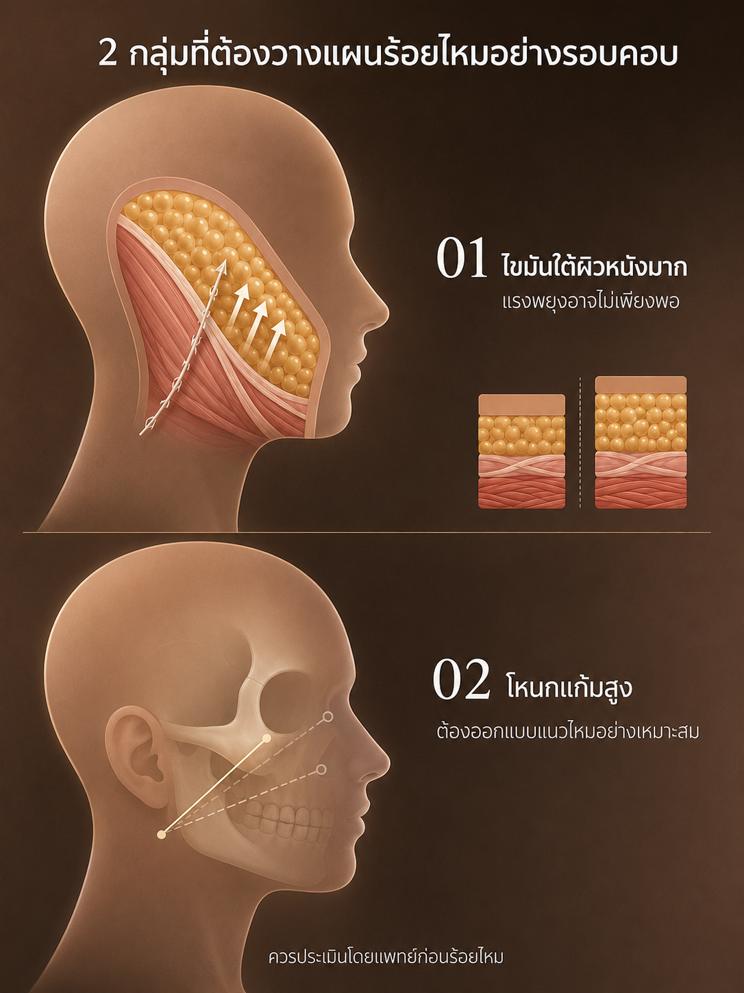 วางแผนการร้อยไหม