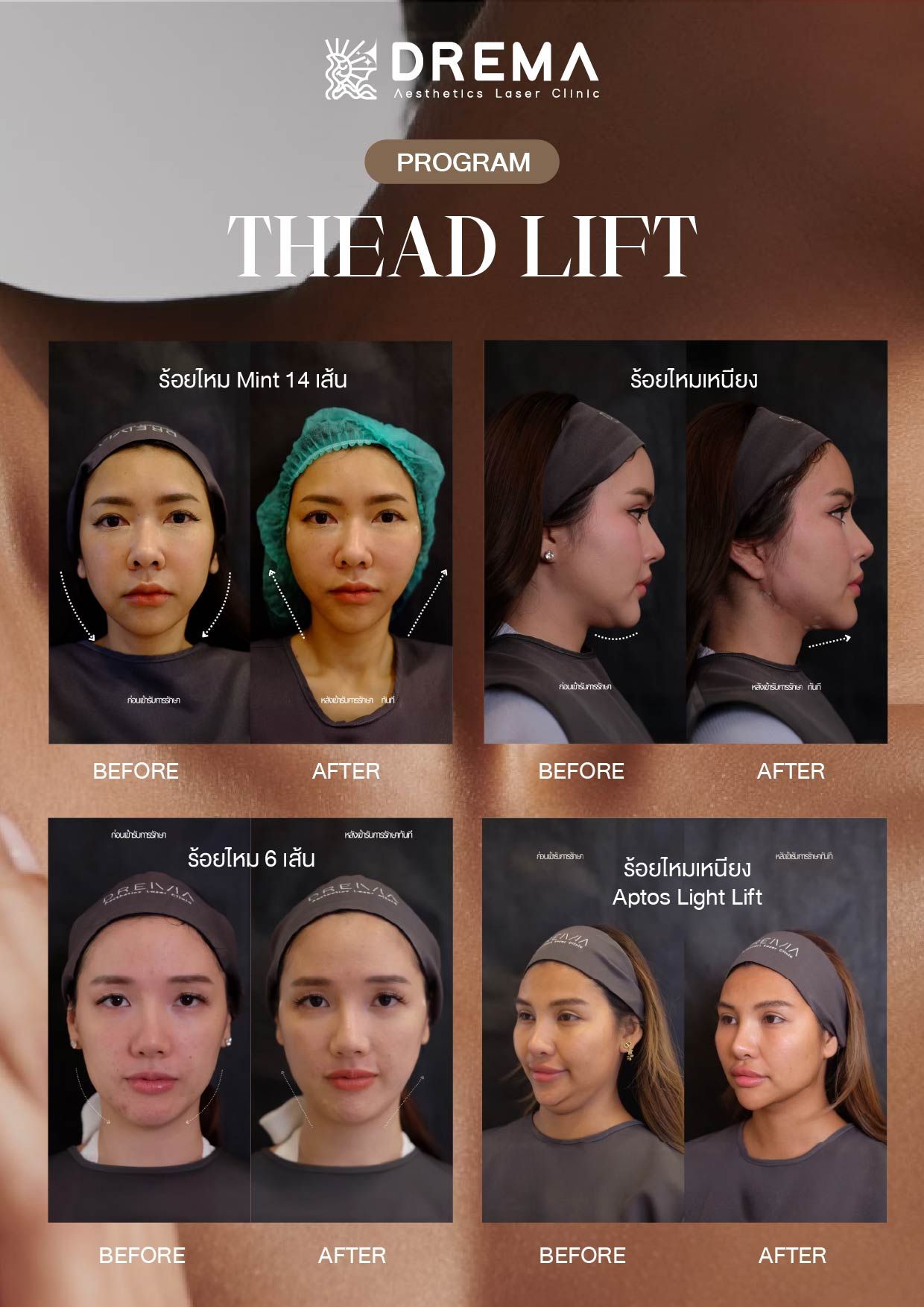 ผลลัพธ์การร้อยไหม