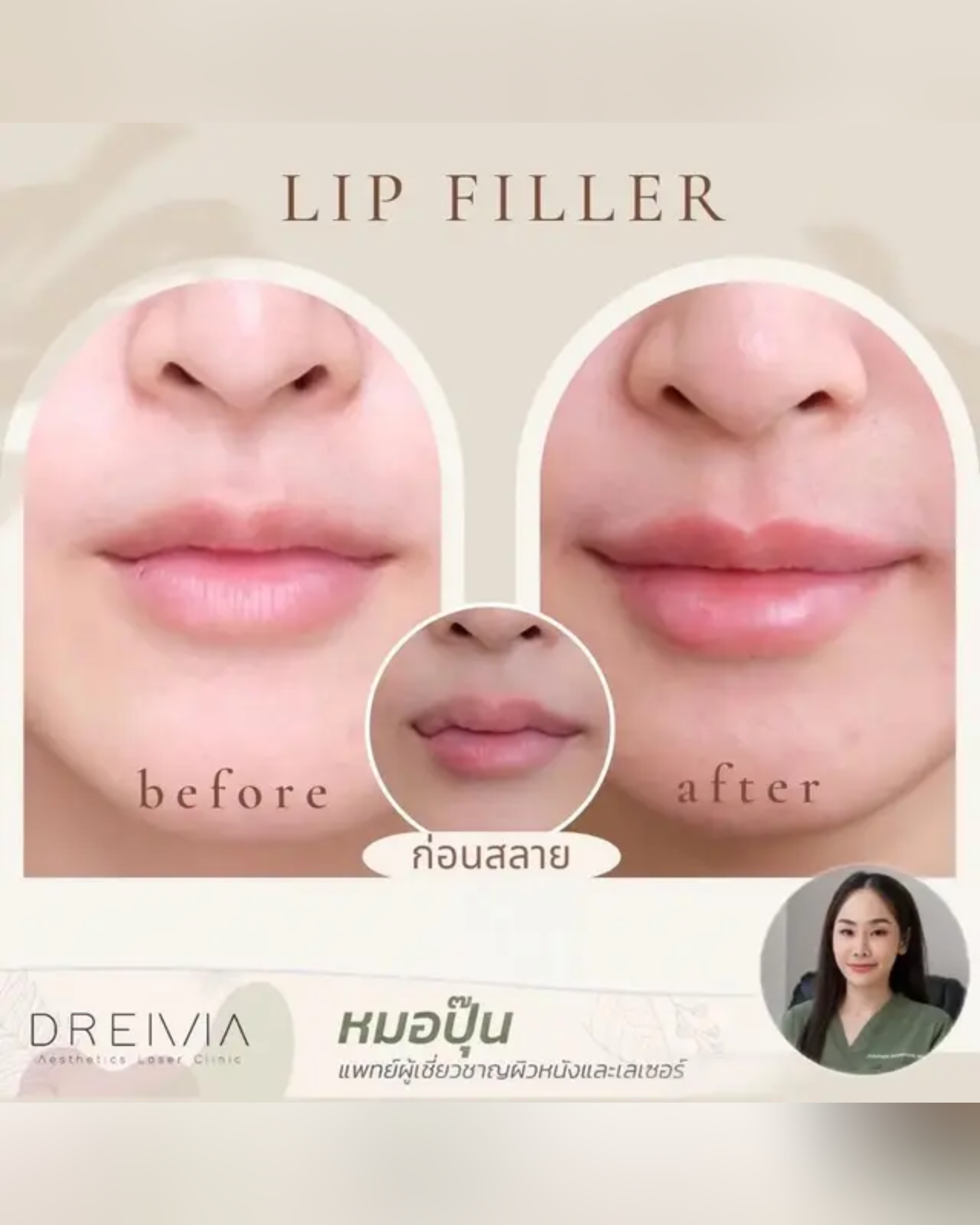 sexy-lip-filler-style - Drema Clinic