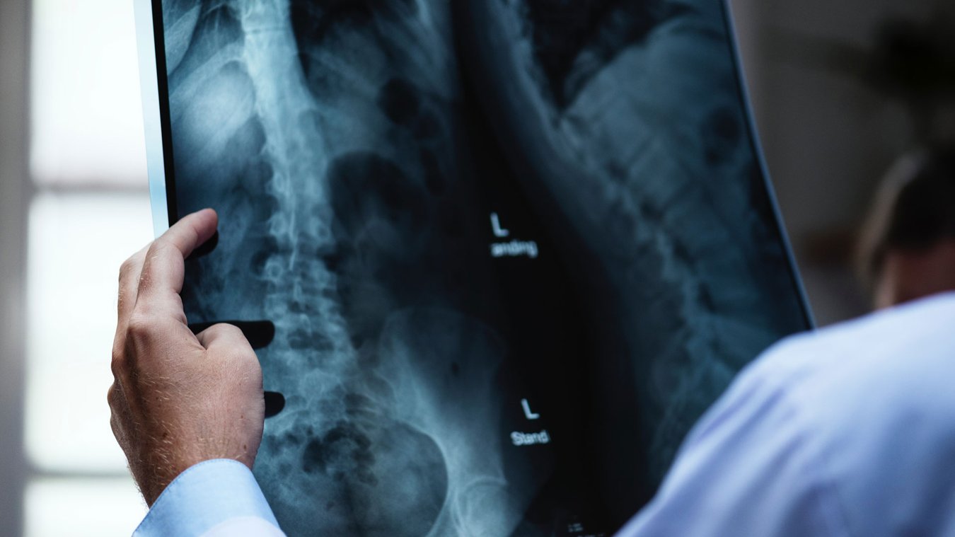 lung_cancer