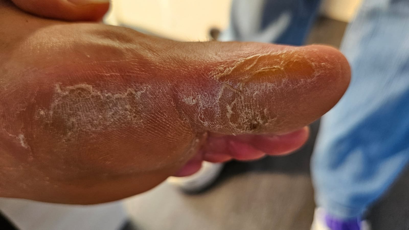 Close-up of the sole of a foot with peeling, cracked skin.