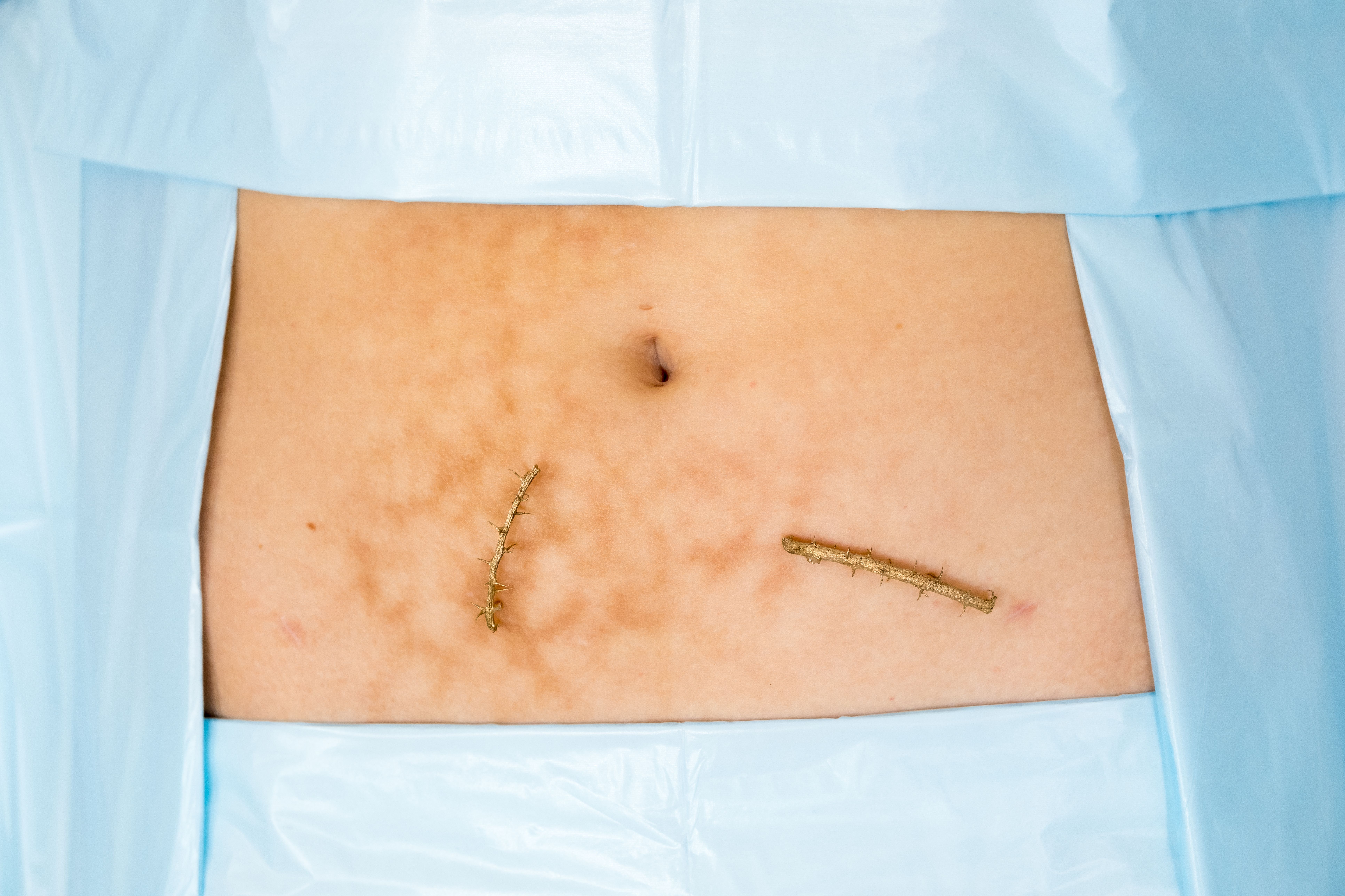 two metal cast thorned sticks lay on a patch of stomach below the belly button surrounded by blue surgical fabric. The skin has visible marks from heat scarring.