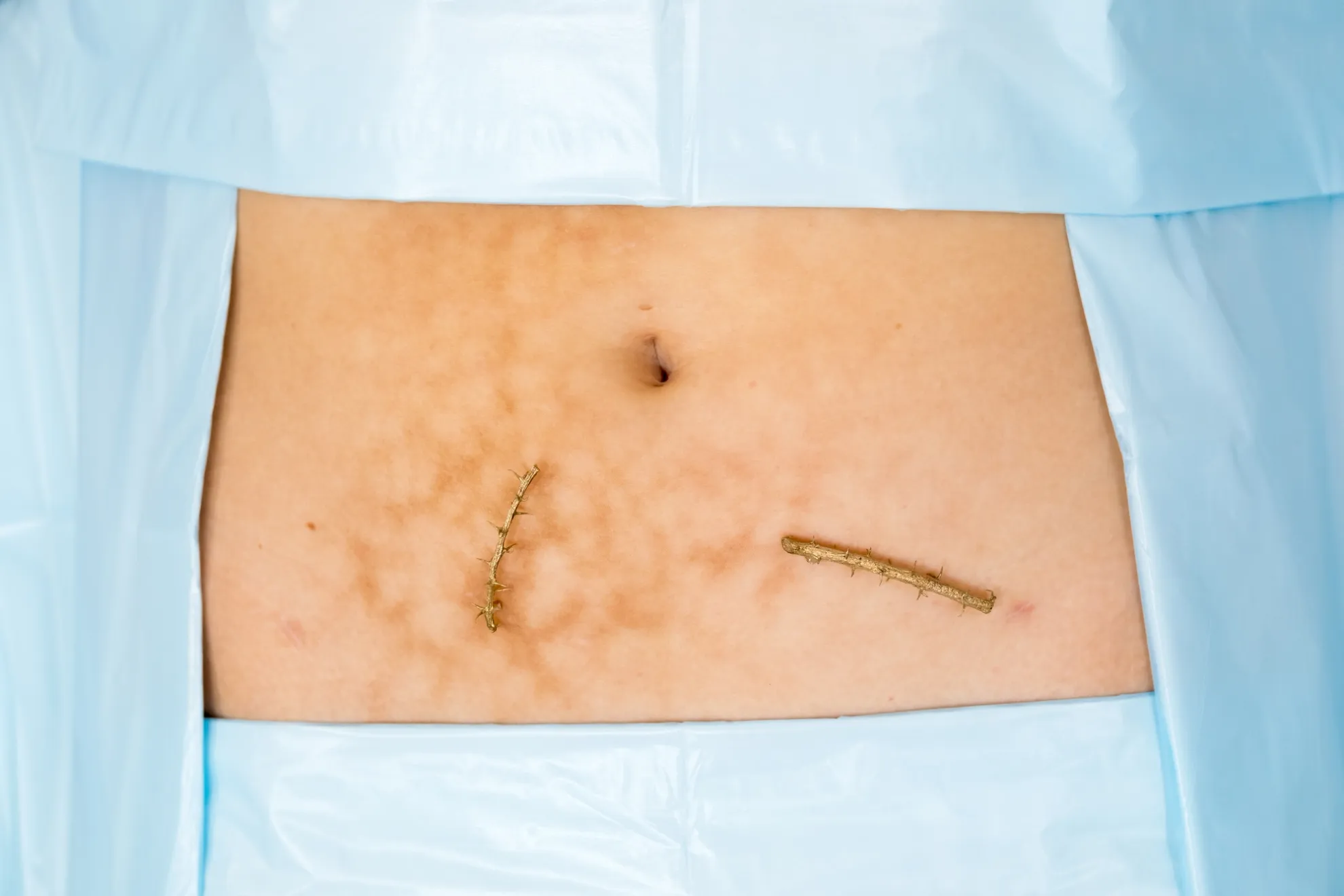 two metal cast thorned sticks lay on a patch of stomach below the belly button surrounded by blue surgical fabric. The skin has visible marks from heat scarring.