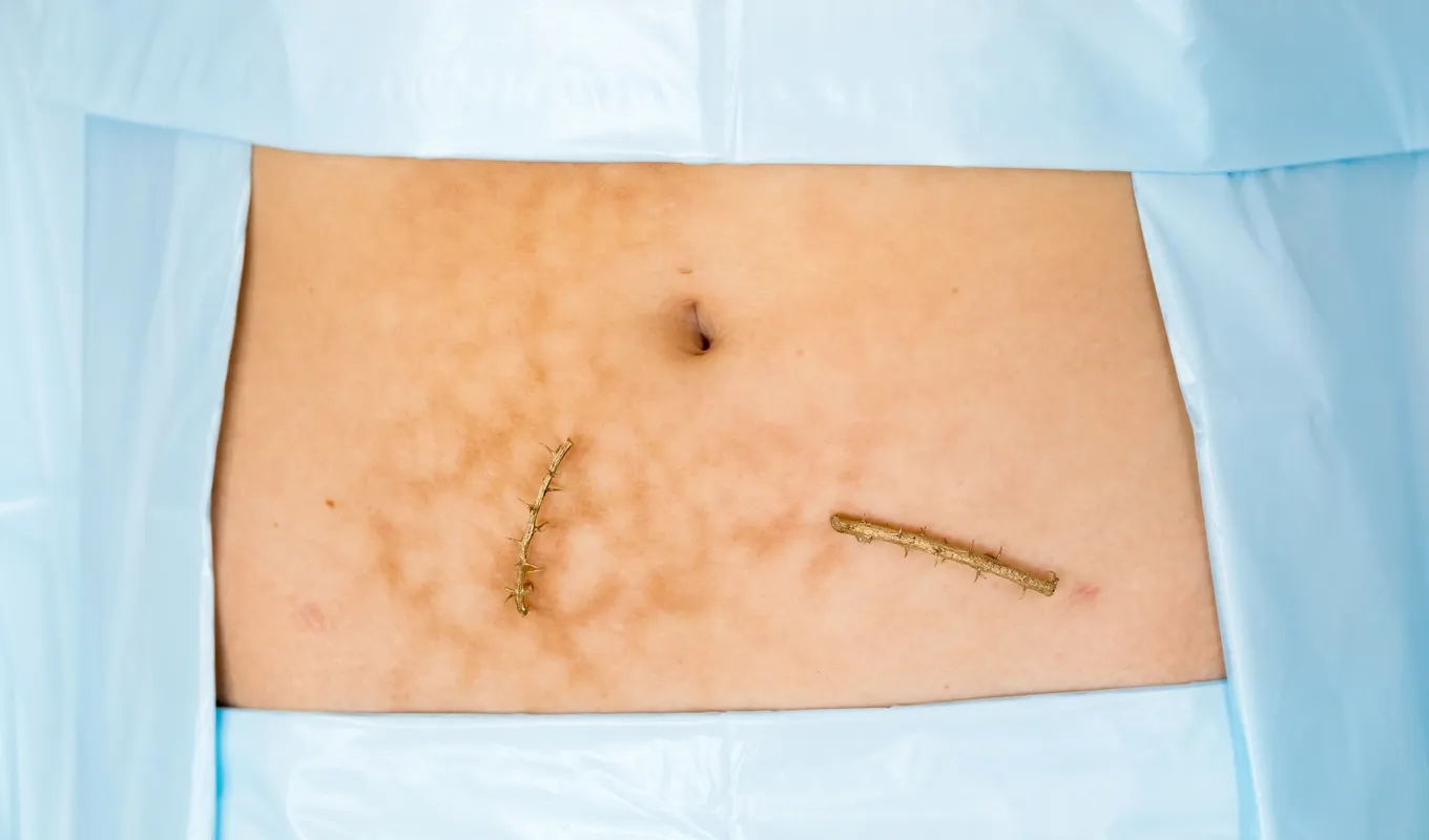 two metal cast thorned sticks lay on a patch of stomach below the belly button surrounded by blue surgical fabric. The skin has visible marks from heat scarring.
